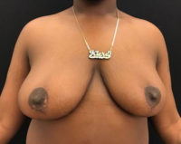 Breast Reduction