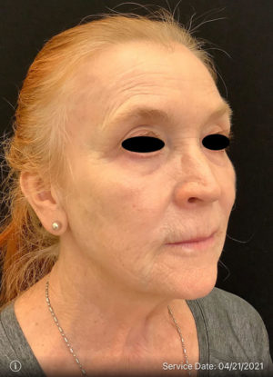 Laser skin resurfacing