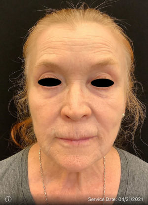 Laser skin resurfacing