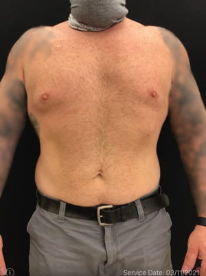 Gynecomastia