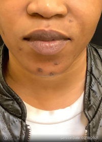 Lip Augmentation