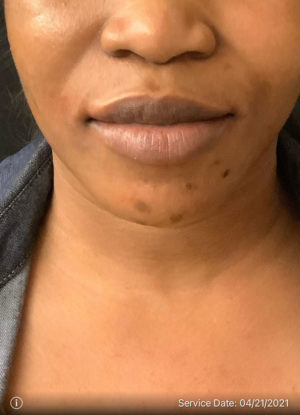 Lip Augmentation