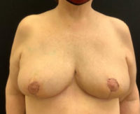 Breast Reduction