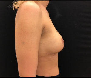 Breast Reduction