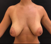 Breast Reduction