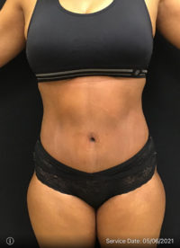 Tummy Tuck