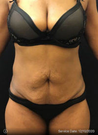 Tummy Tuck