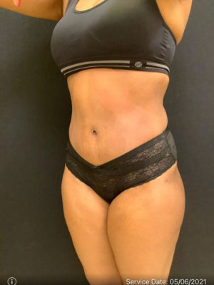 Tummy Tuck