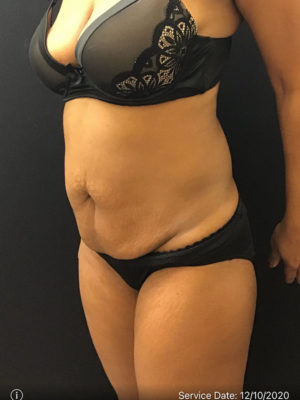 Tummy Tuck