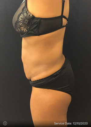 Tummy Tuck