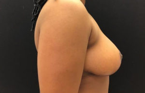 Breast Reduction