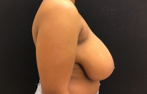 Breast Reduction