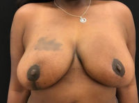 Breast Reduction