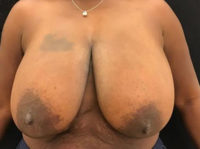 Breast Reduction