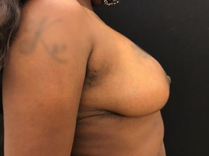Breast Reduction