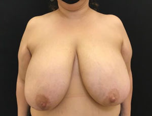 Breast Reduction