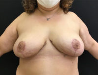 Breast Reduction