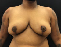 Breast Reduction