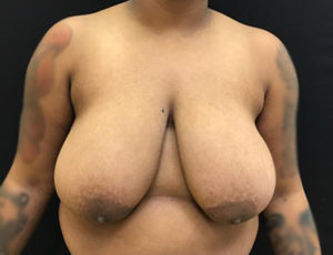 Breast Reduction