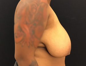 Breast Reduction