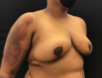 Breast Reduction