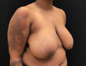 Breast Reduction