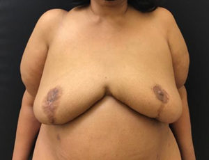 Breast Reduction