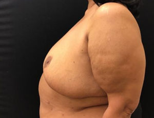 Breast Reduction