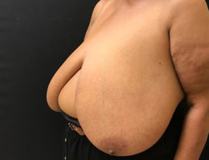 Breast Reduction