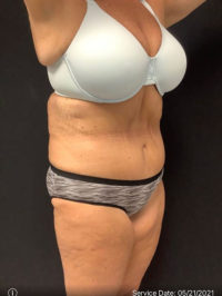 Tummy Tuck