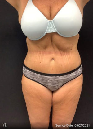 Tummy Tuck