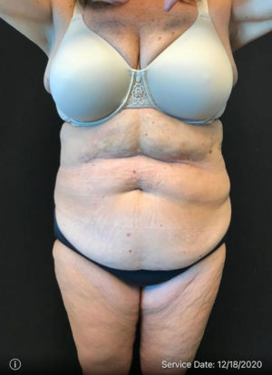 Tummy Tuck