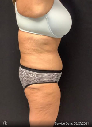 Tummy Tuck