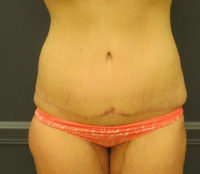 Tummy Tuck