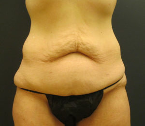 Tummy Tuck