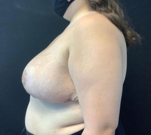 Breast Reduction