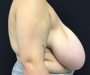 Breast Reduction