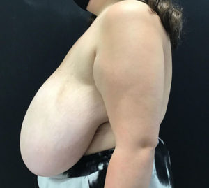 Breast Reduction
