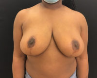 Breast Reduction