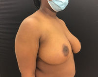 Breast Reduction