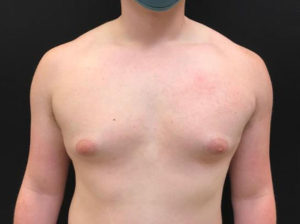 Gynecomastia