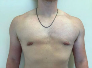 Gynecomastia