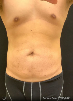 Tummy Tuck