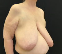 Breast Reduction