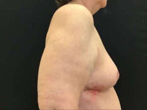 Breast Reduction