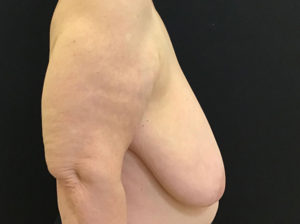 Breast Reduction