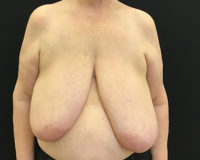 Breast Reduction