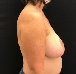Breast Reduction
