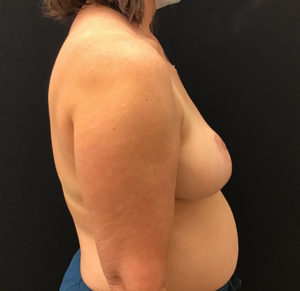 Breast Reduction