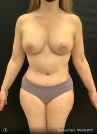 Breast Augmentation